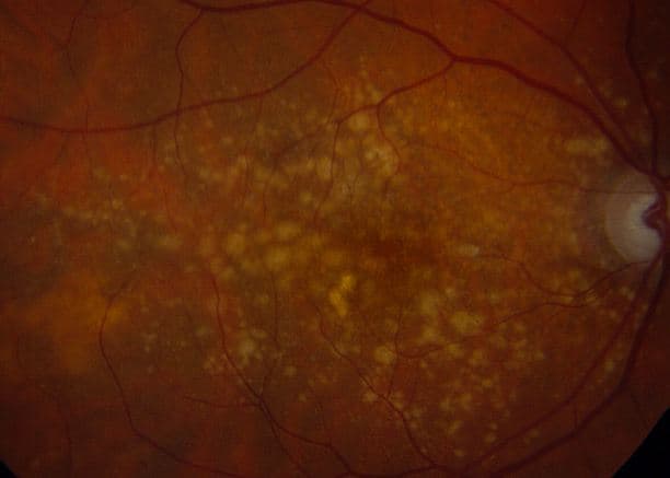 Age related macular degeneration (AMD)