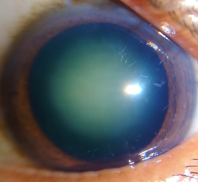 Cataract