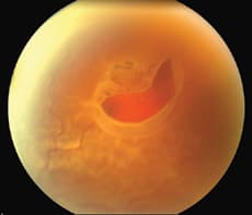 Retinal detachment